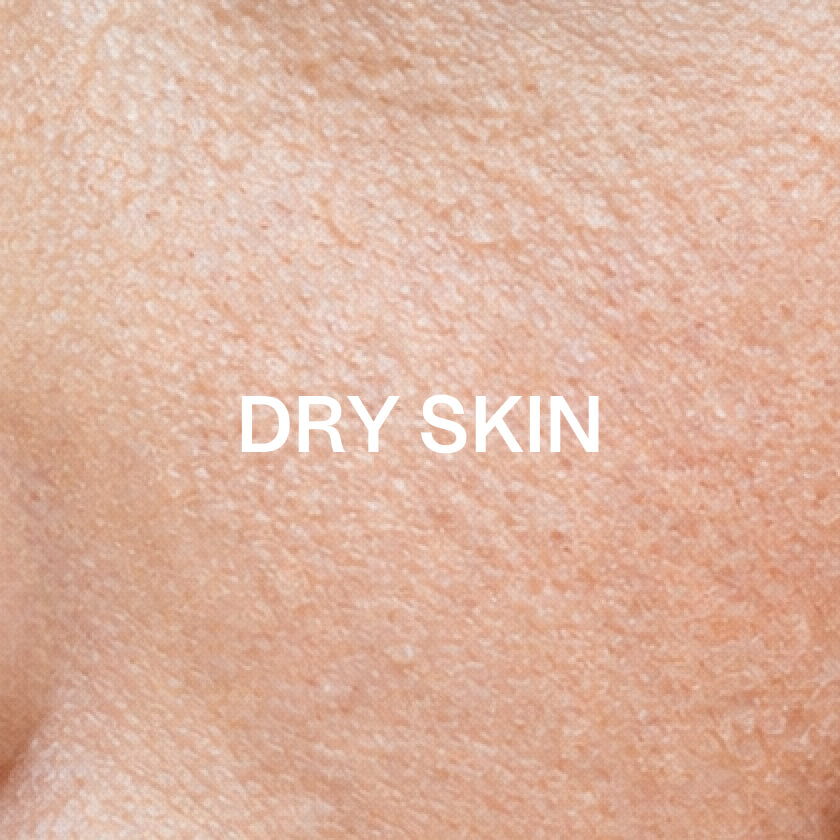Skóra sucha