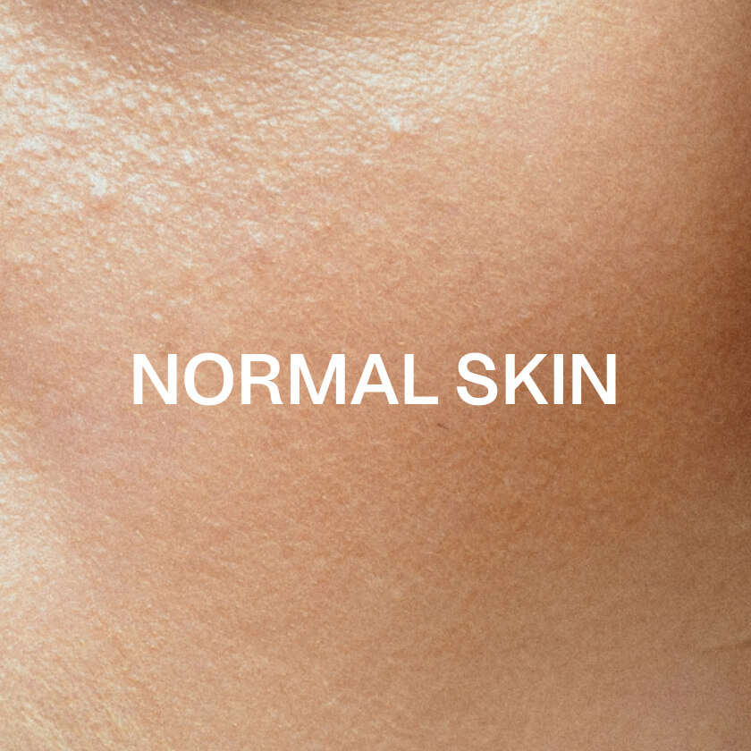 Skóra normalna