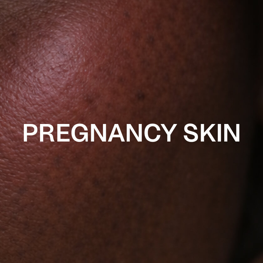Skóra w czasie ciąży