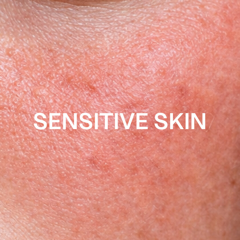 Skóra wrażliwa
