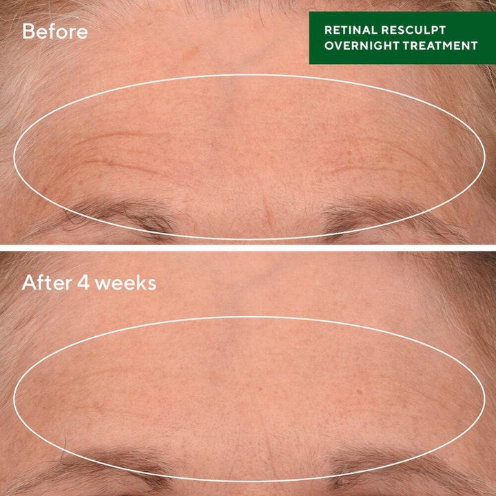 Retinal ReSculpt Treatment