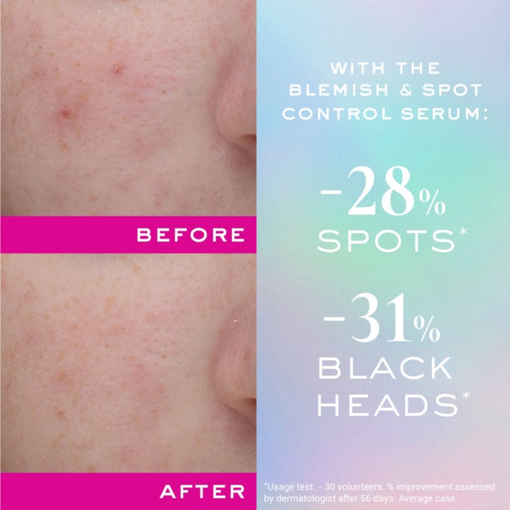 Zinc Power Blemish And Spot Control Serum
