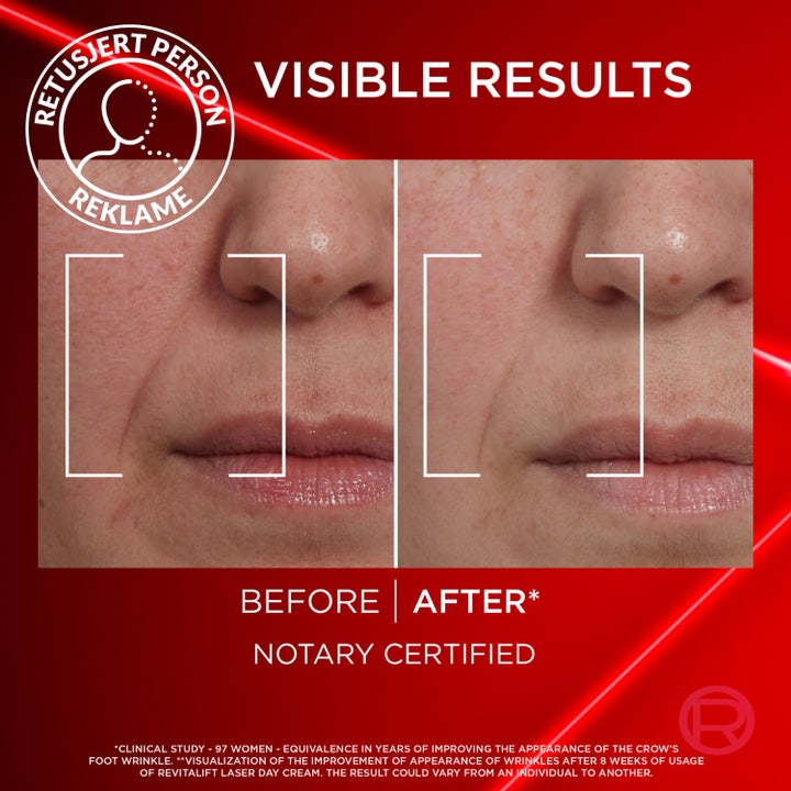 Laser Advance Anti-Ageing Care Day